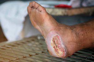 gangrene, dry gangrene, wet gangrene, gas gangrene, Fournier’s gangrene, necrosis, ischemia, peripheral artery disease, diabetes mellitus, smoking, atherosclerosis, frostbite, crush injury, trauma, infection, Clostridium perfringens, anaerobic bacteria, crepitus, foul odor, discoloration, black eschar, blistering, severe pain, numbness, cellulitis, sepsis, systemic toxicity, leukocytosis, fever, tachycardia, hypotension, Doppler ultrasound, ankle-brachial index, wound culture, broad-spectrum antibiotics, surgical debridement, fasciotomy, amputation, revascularization, bypass surgery, angioplasty, hyperbaric oxygen, wound care, negative pressure therapy, glycemic control, smoking cessation, tetanus prophylaxis, anticoagulation, vasopressors, rehabilitation, prosthetics