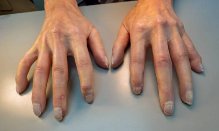 about Scleroderma