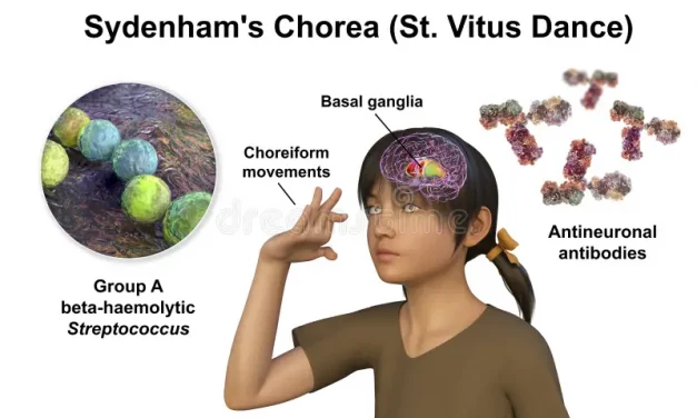 Sydenham’s Chorea