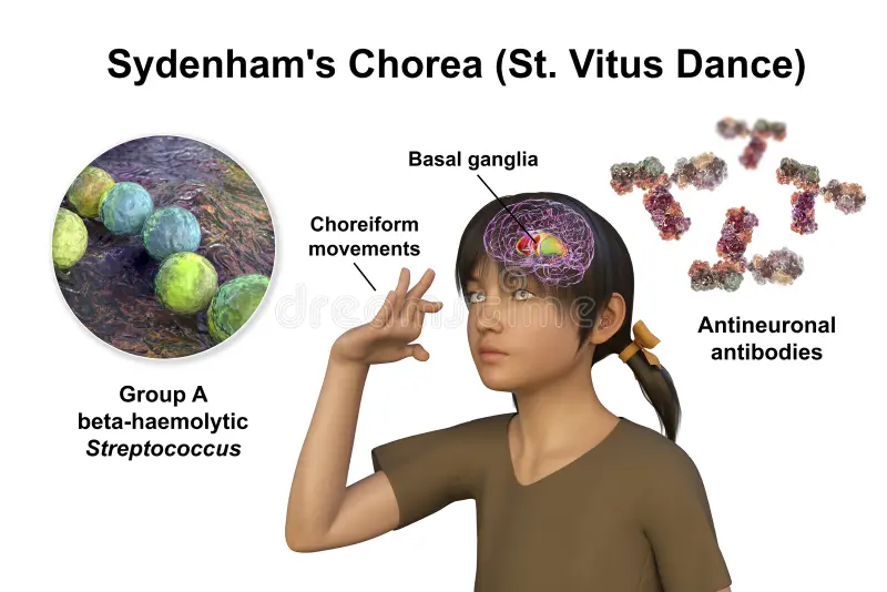 Sydenham’s Chorea
