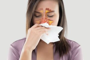 acute sinusitis, chronic rhinosinusitis, rhinosinusitis, CRSwNP, CRSsNP, viral URI, bacterial sinusitis, post-viral, fungal sinusitis, allergic fungal rhinosinusitis, odontogenic sinusitis, nasal congestion, purulent nasal discharge, facial pain, facial pressure, maxillary sinus, ethmoid sinus, frontal sinus, sphenoid sinus, anosmia, hyposmia, postnasal drip, cough, fever, fatigue, halitosis, dental pain, nasal endoscopy, CT sinuses, Lund–Mackay score, allergy testing, eosinophilic inflammation, culture-directed antibiotics, amoxicillin–clavulanate, doxycycline, watchful waiting, intranasal corticosteroids, nasal saline irrigation, decongestants, antihistamines, leukotriene modifiers, low-dose macrolides, dupilumab, functional endoscopic sinus surgery, balloon sinuplasty, septal deviation, turbinate hypertrophy, asthma comorbidity, AERD, smoking cessation