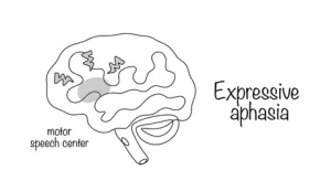 aphasia, expressive aphasia, receptive aphasia, Broca’s aphasia, Wernicke’s aphasia, global aphasia, conduction aphasia, anomic aphasia, transcortical motor aphasia, transcortical sensory aphasia, mixed transcortical aphasia, primary progressive aphasia, nonfluent/agrammatic variant, semantic variant, logopenic variant, stroke, left MCA stroke, ischemic stroke, hemorrhagic stroke, traumatic brain injury, brain tumor, seizures, language impairment, word-finding difficulty, paraphasias, neologisms, agrammatism, fluent speech, nonfluent speech, comprehension deficit, repetition deficit, naming deficit, reading impairment, alexia, writing impairment, agraphia, apraxia of speech, dysarthria, NIH Stroke Scale, CT scan, MRI brain, speech-language pathology, SLP therapy, aphasia recovery, neuroplasticity, constraint-induced language therapy, melodic intonation therapy, augmentative and alternative communication, communication strategies, support groups