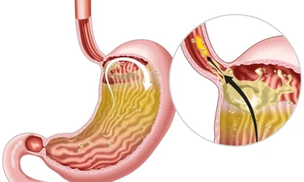 about Barrett’s Esophagus