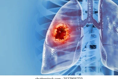 about Lung Cancer