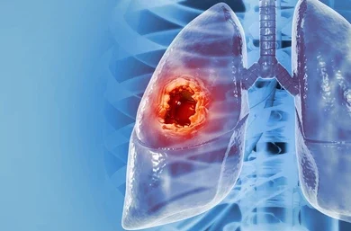 about Lung Cancer