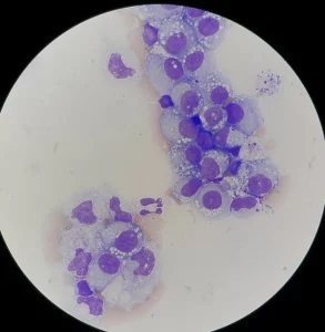 Burkitt lymphoma, BL, non-Hodgkin lymphoma, aggressive B-cell lymphoma, c-MYC translocation, t(8;14)(q24;q32), t(2;8), t(8;22), MYC overexpression, starry-sky appearance, tingible body macrophages, Ki-67 ~100%, EBV association, endemic Burkitt lymphoma, sporadic Burkitt lymphoma, immunodeficiency-associated, malaria cofactor, jaw mass, facial bones, abdominal mass, ileocecal involvement, bowel obstruction, ascites, bone marrow involvement, CNS involvement, lactate dehydrogenase (LDH), tumor lysis syndrome, hyperuricemia, staging workup, PET-CT, bone marrow biopsy, lumbar puncture, intrathecal chemotherapy, methotrexate, cytarabine, rituximab, CODOX-M/IVAC, hyper-CVAD, dose-intense regimens, growth fraction, immunophenotype CD10+, BCL6+, BCL2 negative, minimal residual disease, supportive care, hydration, rasburicase, pediatric oncology, adult oncology, overall prognosis.