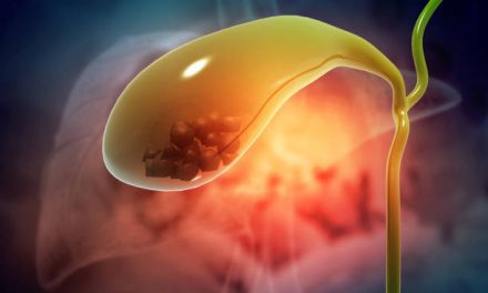 about Gallstones