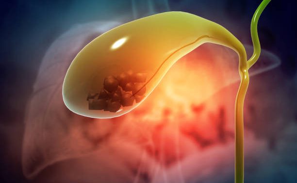 about Gallstones