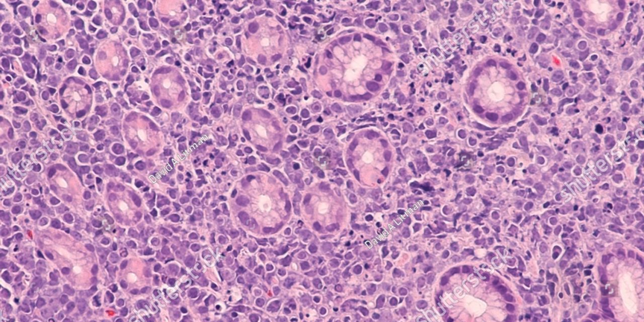 about Burkitt’s Lymphoma