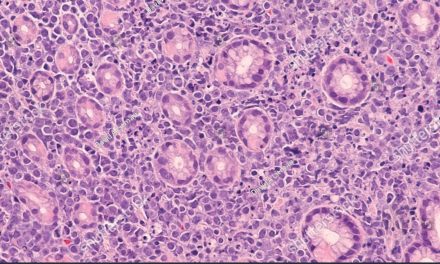 about Burkitt’s Lymphoma
