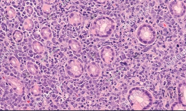 about Burkitt’s Lymphoma