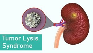 tumor lysis syndrome, TLS, oncology emergency, Cairo–Bishop criteria, laboratory TLS, clinical TLS, spontaneous TLS, high tumor burden, Burkitt lymphoma, acute lymphoblastic leukemia, acute myeloid leukemia, diffuse large B-cell lymphoma, rapidly proliferative tumors, elevated LDH, baseline renal dysfunction, hyperuricemia, xanthine nephropathy, uric acid nephropathy, hyperkalemia, hyperphosphatemia, hypocalcemia, calcium phosphate precipitation, acute kidney injury, oliguria, arrhythmias, cardiac arrest, seizures, tetany, muscle cramps, nausea, vomiting, diarrhea, lethargy, rasburicase, allopurinol, aggressive IV hydration, urine output monitoring, loop diuretics, urinary alkalinization (controversial), dialysis, CRRT, electrolyte monitoring, EKG monitoring, phosphate binders, ICU care, debulking chemotherapy, risk stratification, prevention protocols, pediatric oncology, adult oncology
