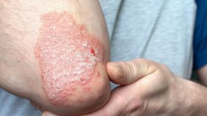 psoriatic arthritis, psoriasis, spondyloarthritis, enthesitis, dactylitis, nail pitting, onycholysis, plaque psoriasis, scalp psoriasis, axial disease, peripheral arthritis, oligoarticular, polyarticular, asymmetric arthritis, sacroiliitis, uveitis, metabolic syndrome, obesity, cardiovascular risk, HLA-B27, genetic predisposition, immune-mediated, IL-17, IL-23, TNF-alpha, biologics, DMARDs, methotrexate, sulfasalazine, leflunomide, apremilast, secukinumab, ixekizumab, ustekinumab, guselkumab, adalimumab, etanercept, infliximab, JAK inhibitors, upadacitinib, tofacitinib, treat-to-target, minimal disease activity, rheumatology, dermatology, ultrasound entheses, MRI sacroiliac, quality of life, patient-reported outcomes, lifestyle modification