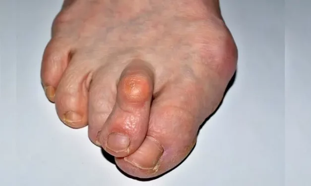 about Psoriatic Arthritis