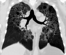about Farmer’s Lung