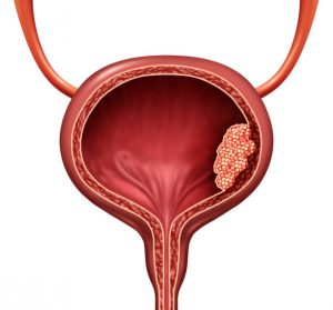 bladder cancer, urothelial carcinoma, transitional cell carcinoma, squamous cell carcinoma, adenocarcinoma, non–muscle invasive, muscle-invasive, carcinoma in situ, hematuria, dysuria, urinary frequency, urinary urgency, smoking risk, aromatic amines, occupational exposure, cyclophosphamide, schistosomiasis, chronic inflammation, urinalysis, urine cytology, FISH test, cystoscopy, blue light cystoscopy, TURBT, intravesical therapy, BCG, mitomycin C, gemcitabine, neoadjuvant chemotherapy, MVAC, cisplatin-based chemo, immunotherapy, pembrolizumab, nivolumab, atezolizumab, FGFR inhibitors, erdafitinib, radical cystectomy, neobladder, ileal conduit, radiation therapy, trimodality therapy, staging TNM, grade WHO/ISUP, surveillance, recurrence risk, progression risk, molecular subtypes, patient support, quality of life