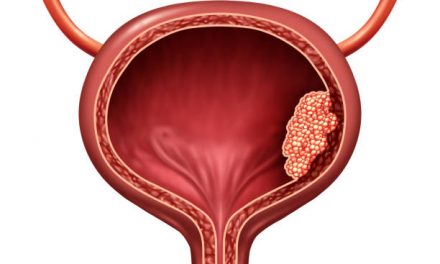Bladder Cancer