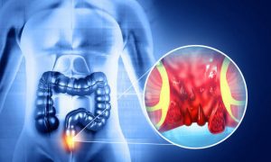 hemorrhoids, piles, internal hemorrhoids, external hemorrhoids, thrombosed hemorrhoid, prolapsed hemorrhoid, rectal bleeding, pruritus ani, anal pain, anal swelling, mucus discharge, constipation, straining, low-fiber diet, pregnancy, postpartum, obesity, sedentary lifestyle, prolonged sitting, chronic diarrhea, portal hypertension, rectal exam, anoscopy, colonoscopy, anal fissure, anal fistula, rubber band ligation, sclerotherapy, infrared coagulation, hemorrhoidectomy, stapled hemorrhoidopexy, Doppler-guided HAL-RAR, sitz baths, witch hazel, topical hydrocortisone, lidocaine ointment, stool softeners, fiber supplements, psyllium, adequate hydration, high-fiber diet, avoid straining, pelvic floor therapy, pain management, recurrence prevention, complications, iron-deficiency anemia, strangulation, colorectal surgeon, evidence-based guidelines