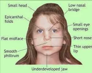 DiGeorge syndrome, 22q11.2 deletion, velocardiofacial syndrome, conotruncal anomalies, tetralogy of Fallot, interrupted aortic arch, truncus arteriosus, ventricular septal defect, palatal abnormalities, cleft palate, submucous cleft, velopharyngeal insufficiency, hypocalcemia, hypoparathyroidism, thymic hypoplasia, immunodeficiency, T-cell lymphopenia, recurrent infections, autoimmunity, developmental delay, learning difficulties, ADHD, autism spectrum, psychiatric disorders, schizophrenia risk, characteristic facies, ear anomalies, renal anomalies, skeletal abnormalities, scoliosis, feeding difficulties, failure to thrive, speech therapy, cardiac surgery, calcium supplementation, vitamin D, live vaccine precautions, genetic testing, FISH, chromosomal microarray, MLPA, prenatal diagnosis, chorionic villus sampling, amniocentesis, autosomal dominant, variable expressivity, multidisciplinary care, patient support groups, early intervention, prognosis