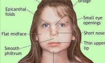 DiGeorge Syndrome