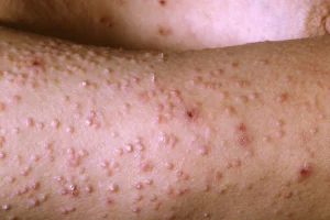 amyloidosis, al amyloidosis, aa amyloidosis, attr amyloidosis, transthyretin, wild-type attr, hereditary attr, light chain, serum free light chains, monoclonal gammopathy, plasma cell dyscrasia, multiple myeloma, cardiomyopathy, restrictive cardiomyopathy, HFpEF, neuropathy, peripheral neuropathy, autonomic neuropathy, nephrotic syndrome, proteinuria, renal insufficiency, hepatomegaly, macroglossia, periorbital purpura, carpal tunnel syndrome, echocardiogram, speckled myocardium, strain imaging, bone scintigraphy, pyp scan, sap scintigraphy, biopsy, congo red, apple-green birefringence, mass spectrometry typing, genetic testing, ttr gene, tafamidis, patisiran, inotersen, vutrisiran, daratumumab, bortezomib, cyclophosphamide, dexamethasone, stem cell transplant, supportive care, diuretics, prognosis, early detection