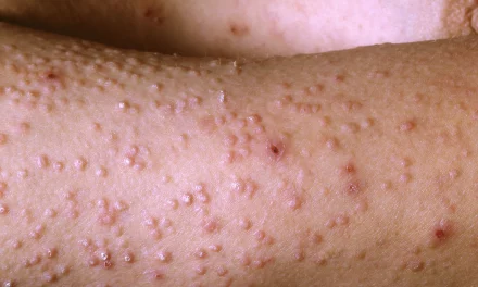 About Amyloidosis