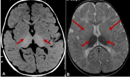 Jewish Inherited Diseases: Tay-Sachs and Canavan
