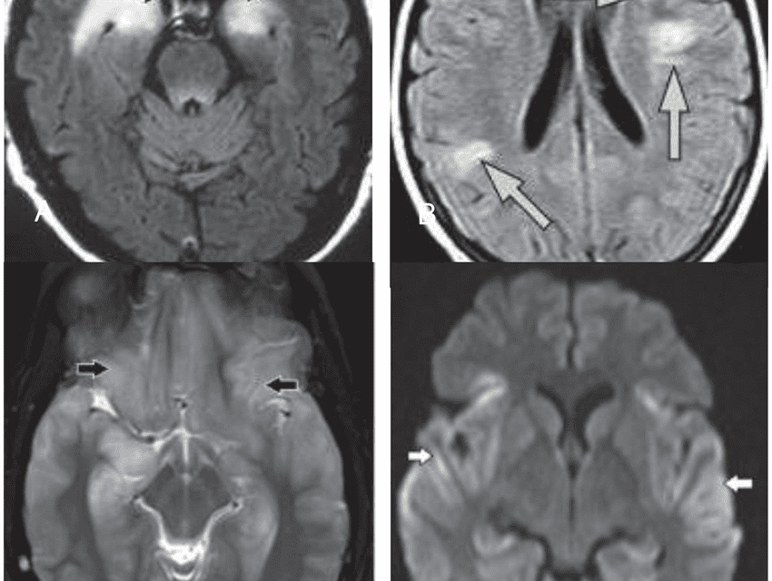 Limbic Encephalitis