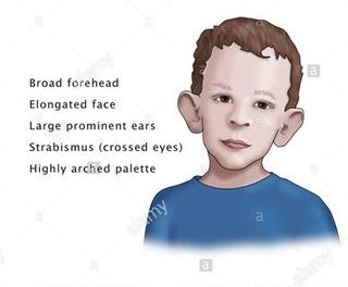 Fragile X and Klinefelter Syndromes