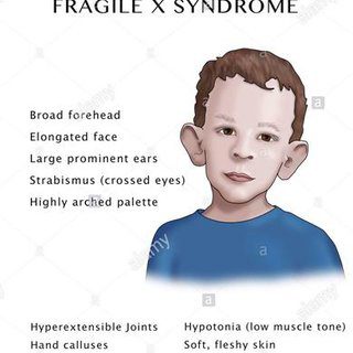 Fragile X and Klinefelter Syndromes
