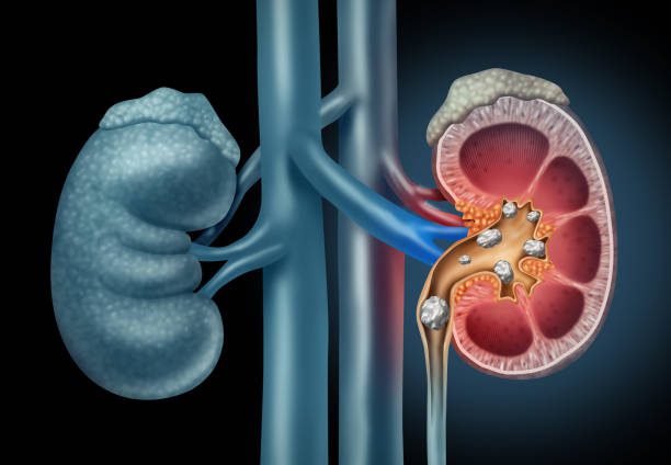 Kidney Stones and How To Treat Them Naturally