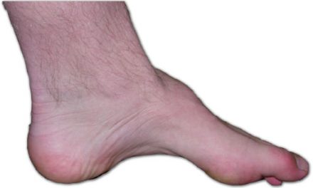 Charcot-Marie-Tooth – CMT
