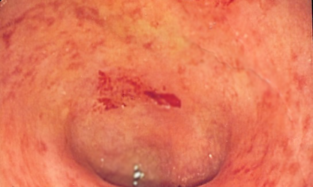 Ulcerative Colitis