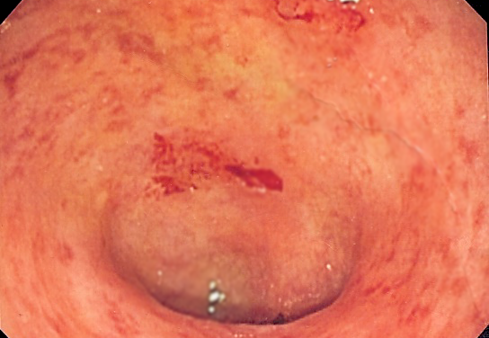 Ulcerative Colitis