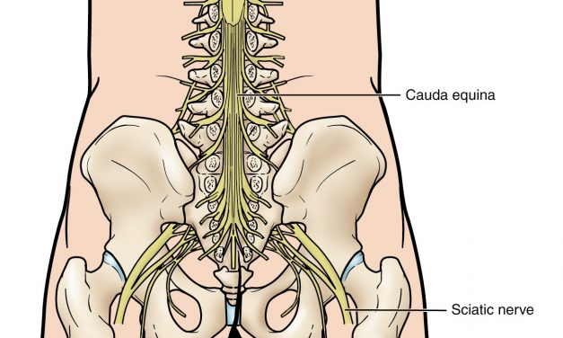 Cauda Equina Syndrome