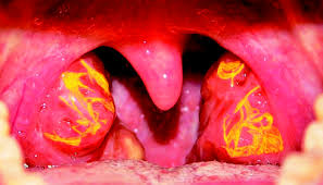 Tangier Disease