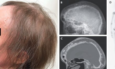 Paget’s Disease