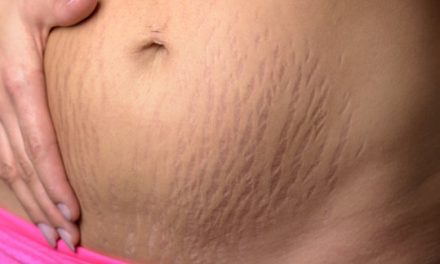 Avoiding Stretch Marks