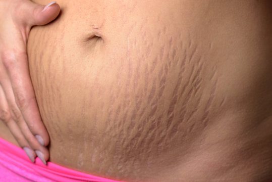 Avoiding Stretch Marks