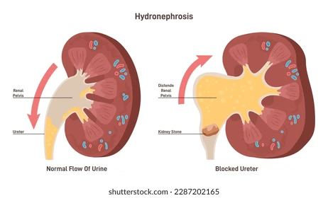 Hydronephrosis