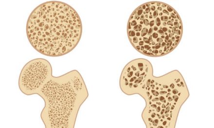 Healthy Tips To Avoid Osteoporosis