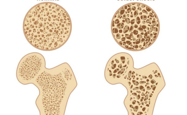 Healthy Tips To Avoid Osteoporosis
