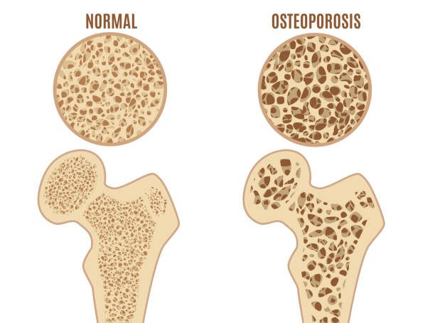 Healthy Tips To Avoid Osteoporosis