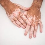 Vitiligo