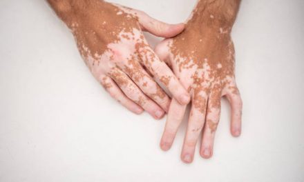 Vitiligo