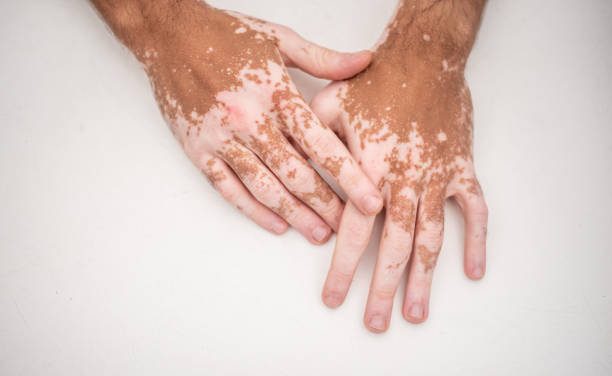 Vitiligo
