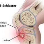 Osgood-Schlatter Disease
