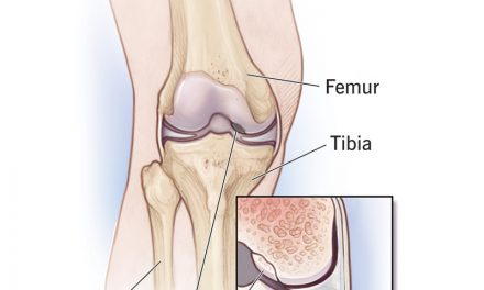 About Osteochondritis Dissecans