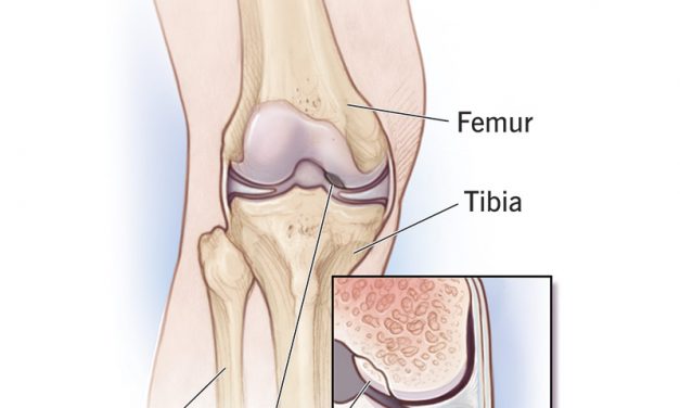 About Osteochondritis Dissecans